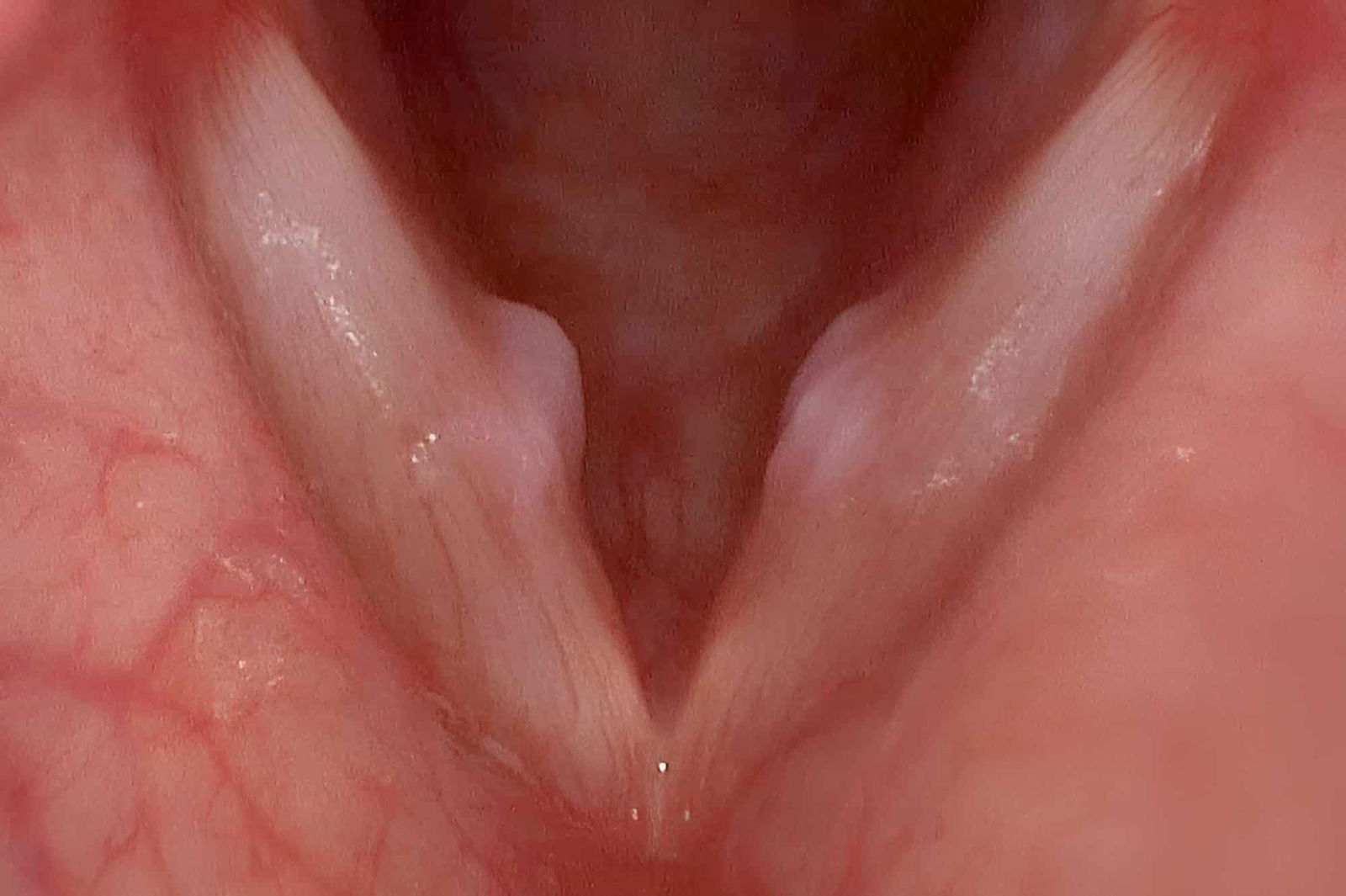 Causes_and_Risk_Factors_of_Vocal_Nodules