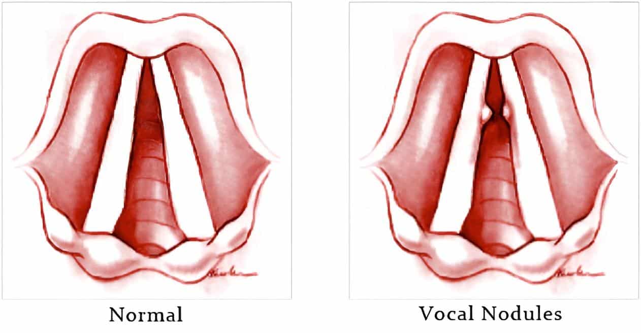 Do_I_Have_Vocal_Nodules_Self-Assessment_Quiz