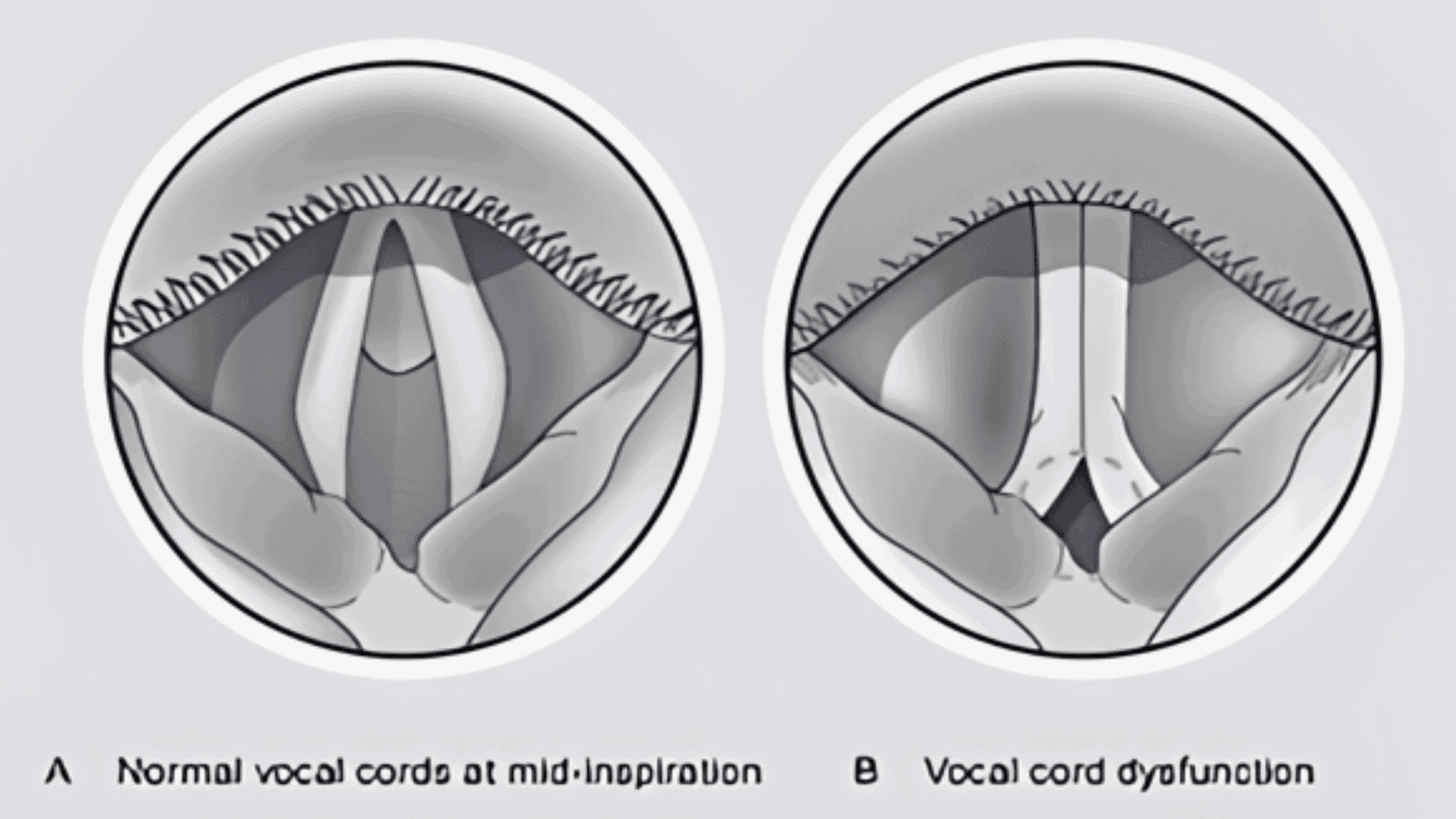 What_is_Vocal_Cord_Dysfunction