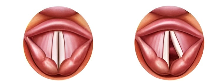 A Comprehensive Guide on Paralyzed Vocal Cord Exercises