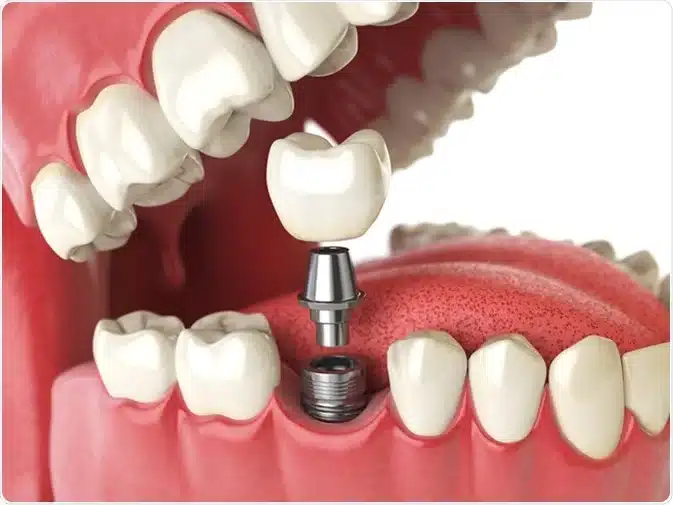 Technique Of Dental Implants