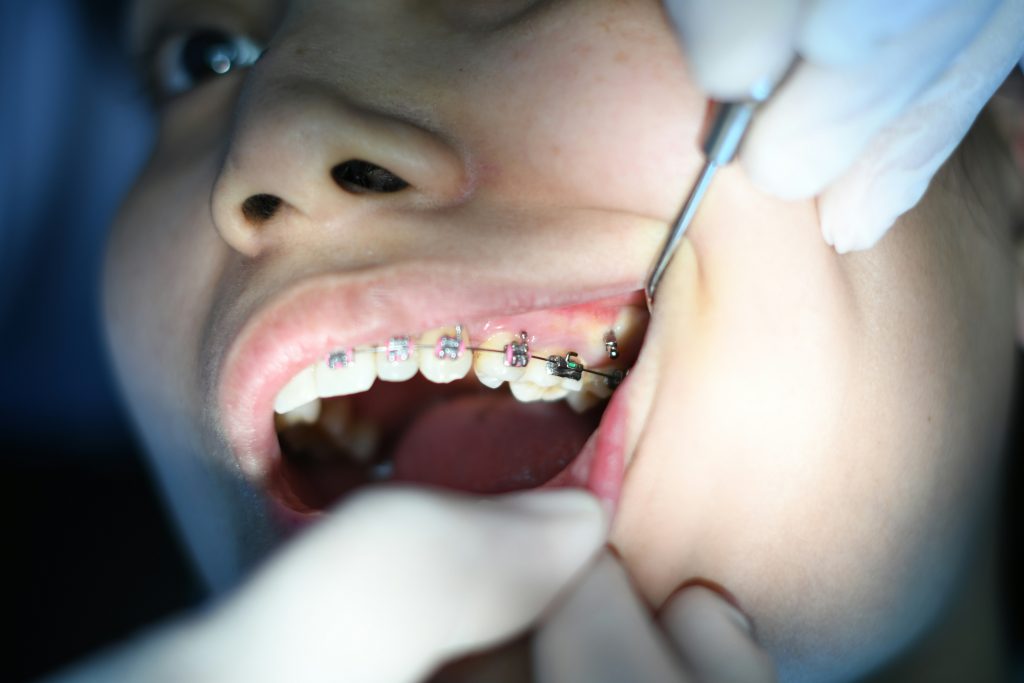 Why Customized Dental Plans Are Essential for Children with Special Needs