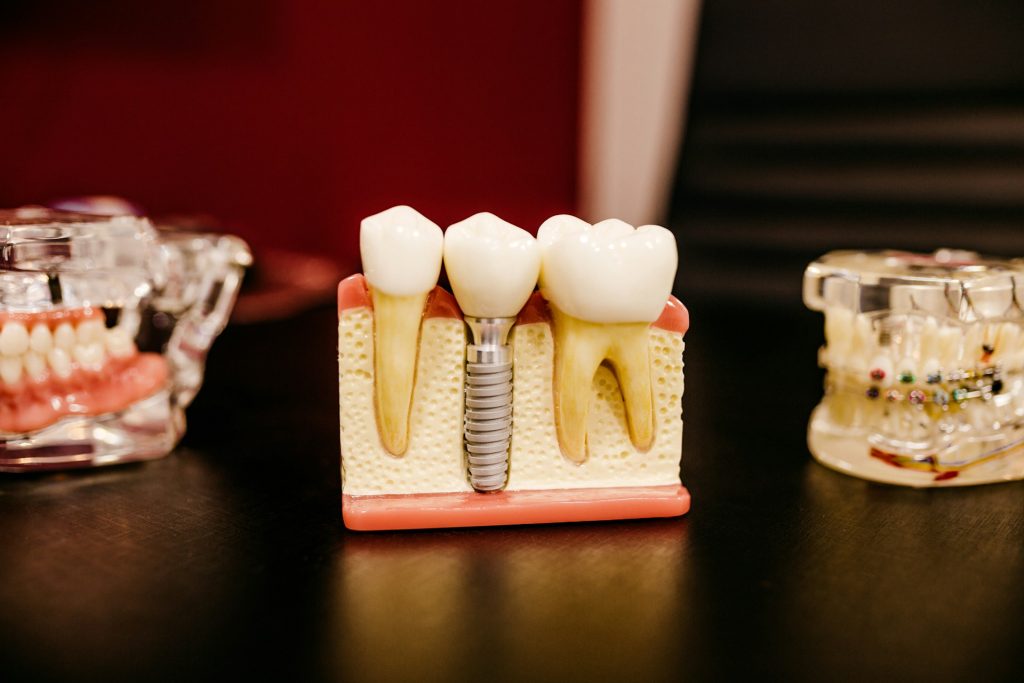 Titanium Dental Implants vs. Zirconia Implants